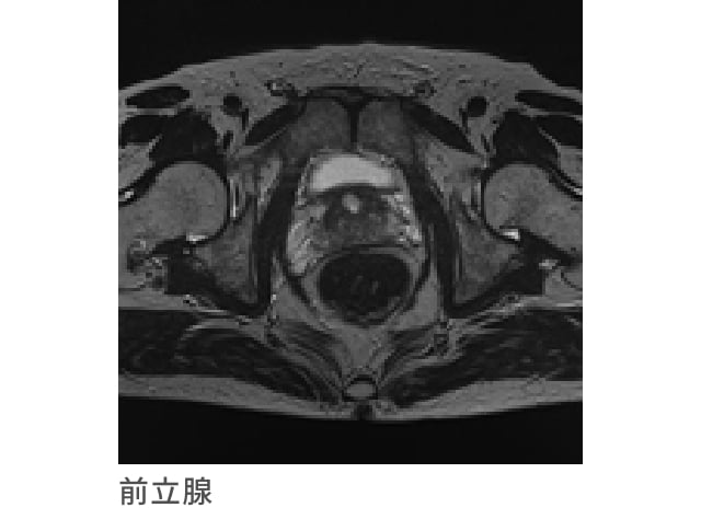 ハイリスク前立腺がんの平均余命